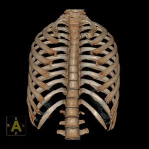 Snowboarding in Xinjiang - China Snow Trip | 滑雪的尽头 竟然真的是骨科